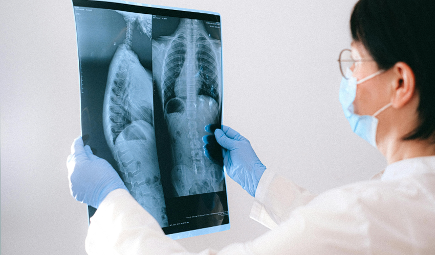 Tuberculoza poate evolua în tăcere, uneori fără tuse