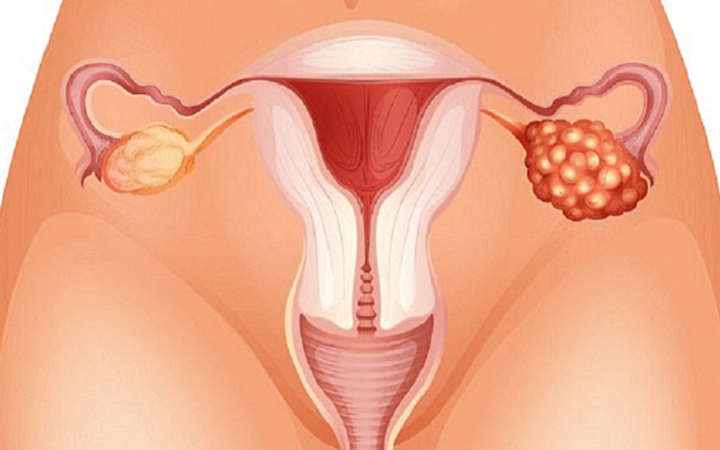 Cancerul ovarian nu începe în ovare: „Ucigașul silențios” începe în trompele uterine