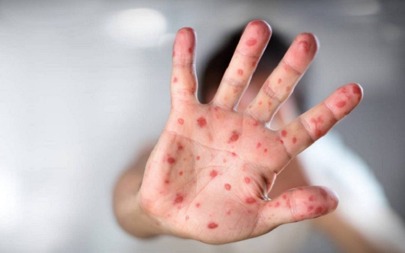 Avem 306 cazuri confirmate de rujeolă. Raionul cel mai afectat rămâne Ceadâr-Lunga 