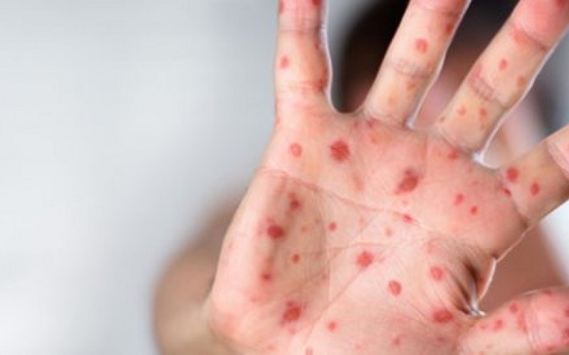 Frații bebelușului de o lună și jumătate, verișorul și un vecin, suspectați că ar avea rujeolă