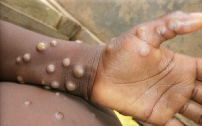 Tot ce știm acum despre variola maimuței – ce rol are sexul și unde s-au depistat cele mai multe cazuri. Ce măsuri trebuie să ia țările în perioada imediat următoare