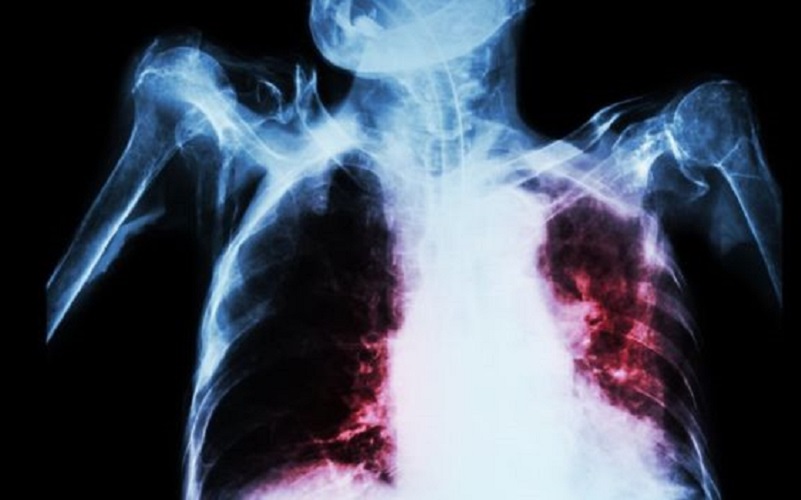 Un vaccin revoluționar contra tuberculozei ar putea schimba esențial modul cum luptăm cu boala